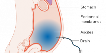 ascites