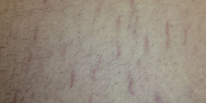 stretch mark