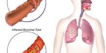 bronchitis