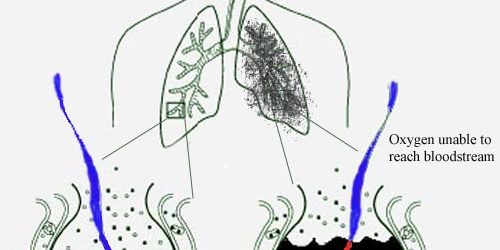 Pneumonia